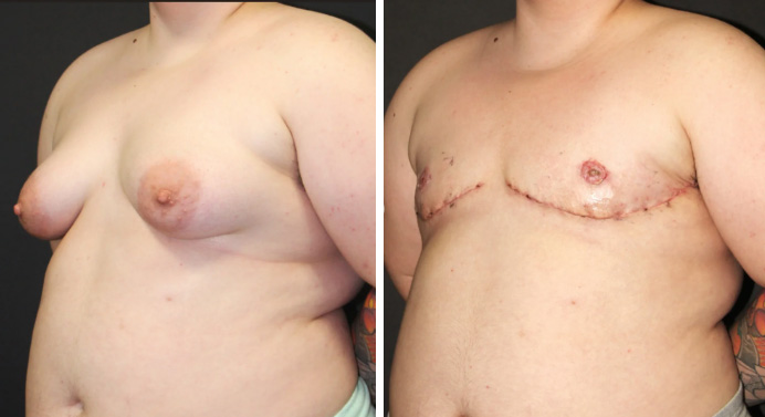 FTM-top-surgery-dr-garg-before-after-01