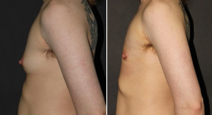 FTM-top-surgery-dr-garg-before-after-02-03