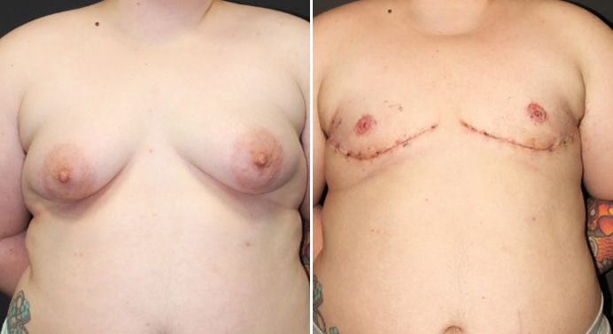 FTM-top-surgery-dr-garg-before-after-02