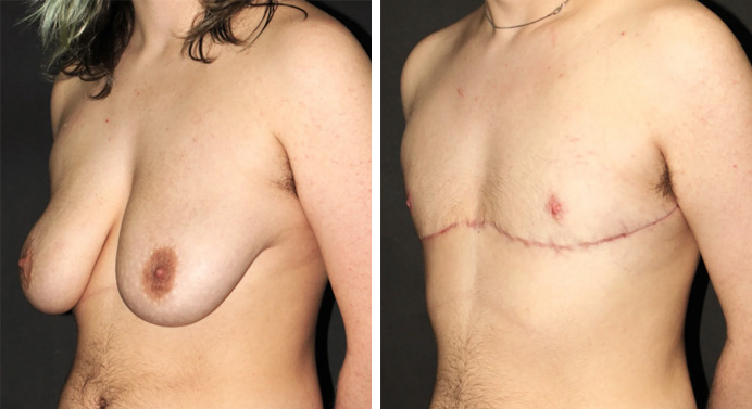 FTM-top-surgery-dr-garg-before-after-03-01