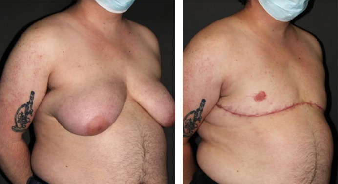 FTM-top-surgery-dr-garg-before-after-04-01