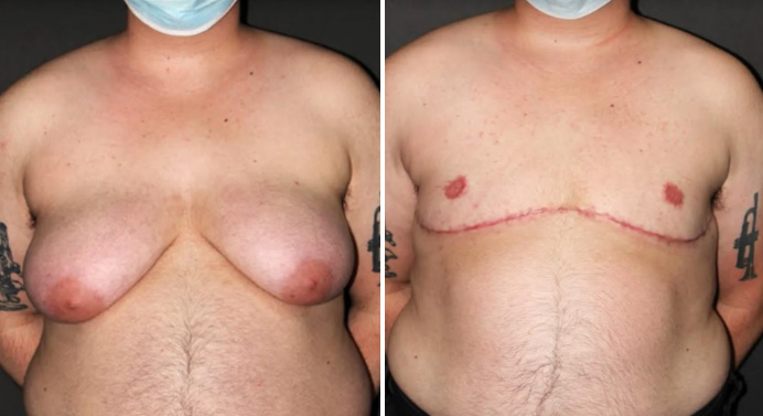 FTM-top-surgery-dr-garg-before-after-04-03