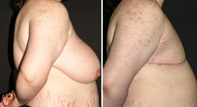 FTM-top-surgery-dr-garg-before-after-05-02