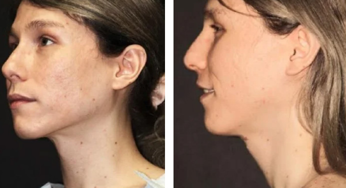 tracheal-shave-dr-garg-before-after-01